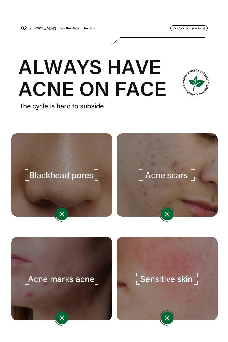 Tea Tree Acne Removal Facial Serum Anti Acne Pimples Remover Black head Pores Shrinking Essential Oil Control Smooth Skin Care
