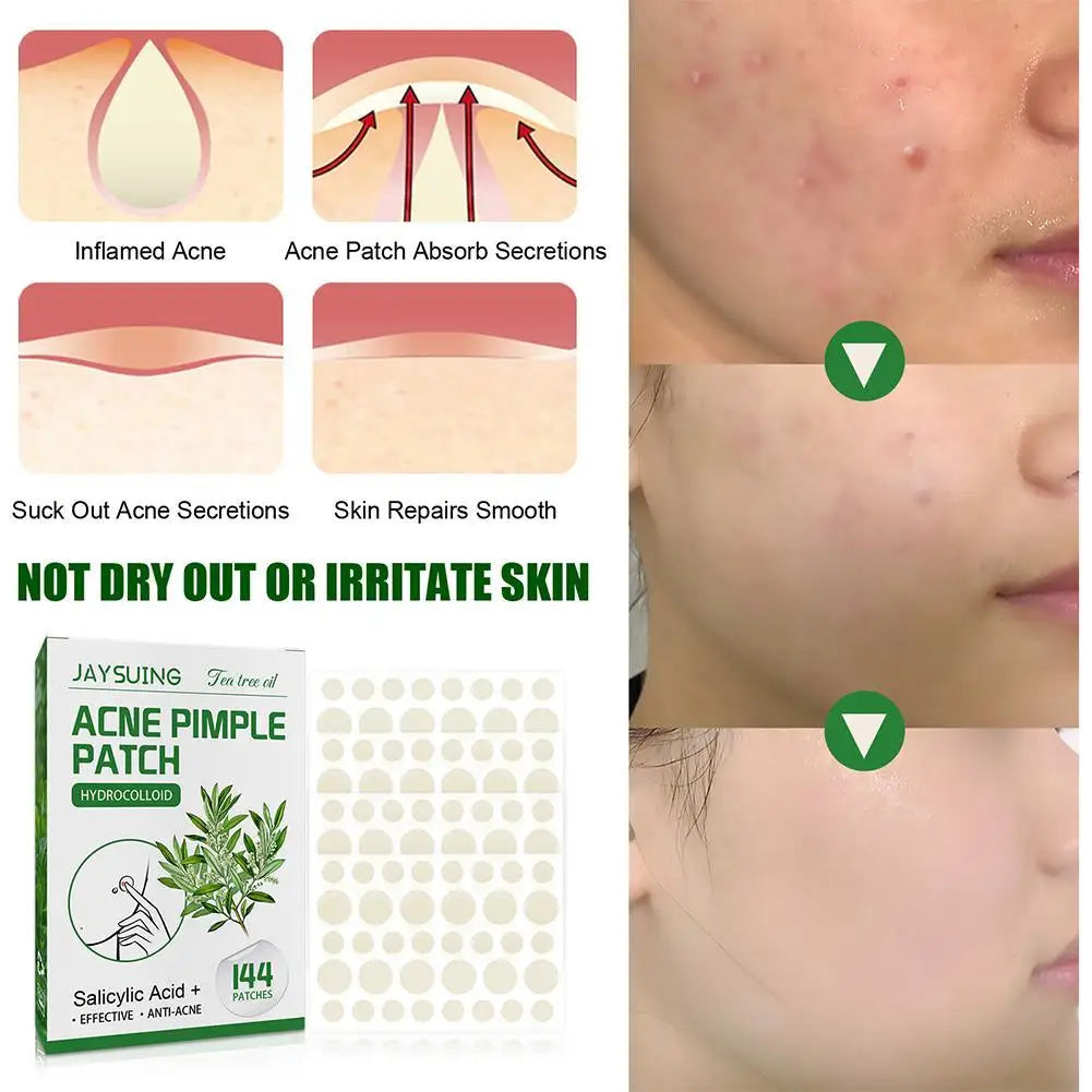 Tea Tree Oil Acne Pimple Patches Translucent Matte Hydrocolloid Salicylic Acid Tea Tree Oil For Inflamed Acne Improve Whiteheads