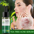 Tea Tree Acne Removal Serum: Anti-Acne & Pore Minimizer - Aura Beauty - aura beauty cosmetics