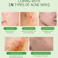 Tea Tree Acne Removal Serum: Anti-Acne & Pore Minimizer - Aura Beauty - aura beauty cosmetics