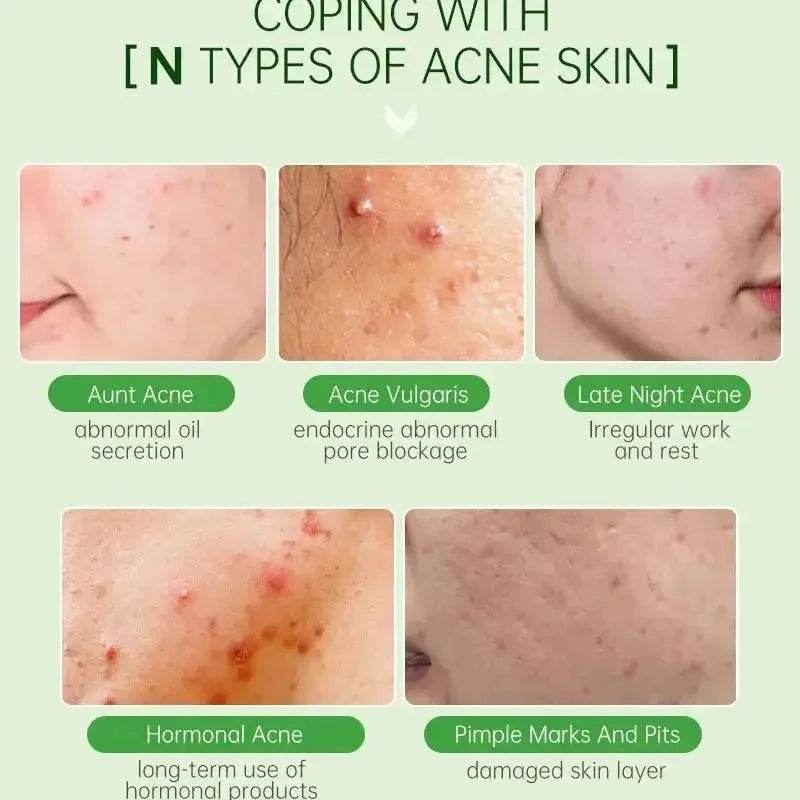 Tea Tree Acne Removal Facial Serum Anti Acne Pimples Remover Black head Pores Shrinking Essential Oil Control Smooth Skin Care